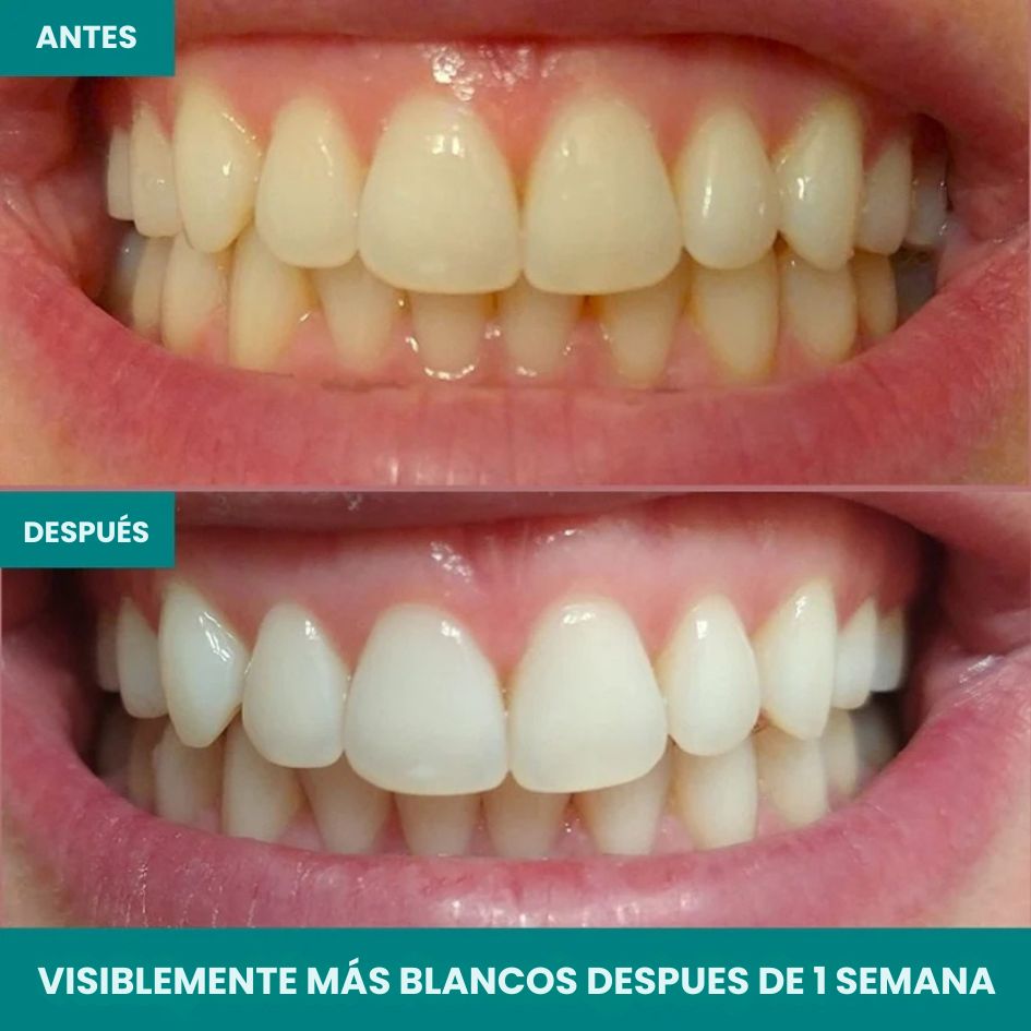 PureSmile™ Tratamiento Avanzado 2 Semanas